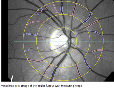 中央视网膜小动脉当量 (CRAE)：动脉模型血管直径,中央视网膜静脉当量 (CRVE)：静脉模型血管直径,小动脉与小静脉比率 (AVR)：CRAE/CRVE 比率分析